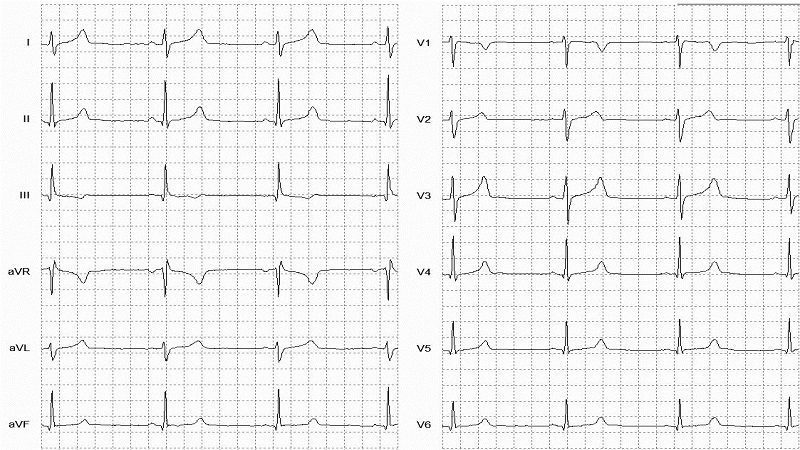 Sinus Bradycardia 12 Lead EKG